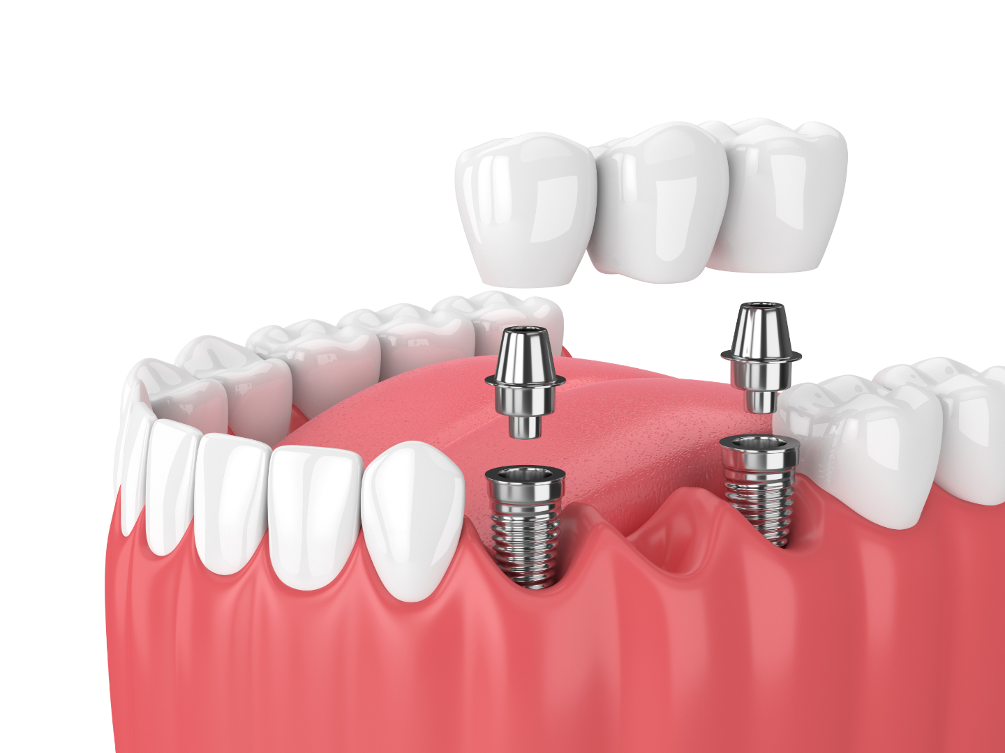 Affordable Dental Implants Near You