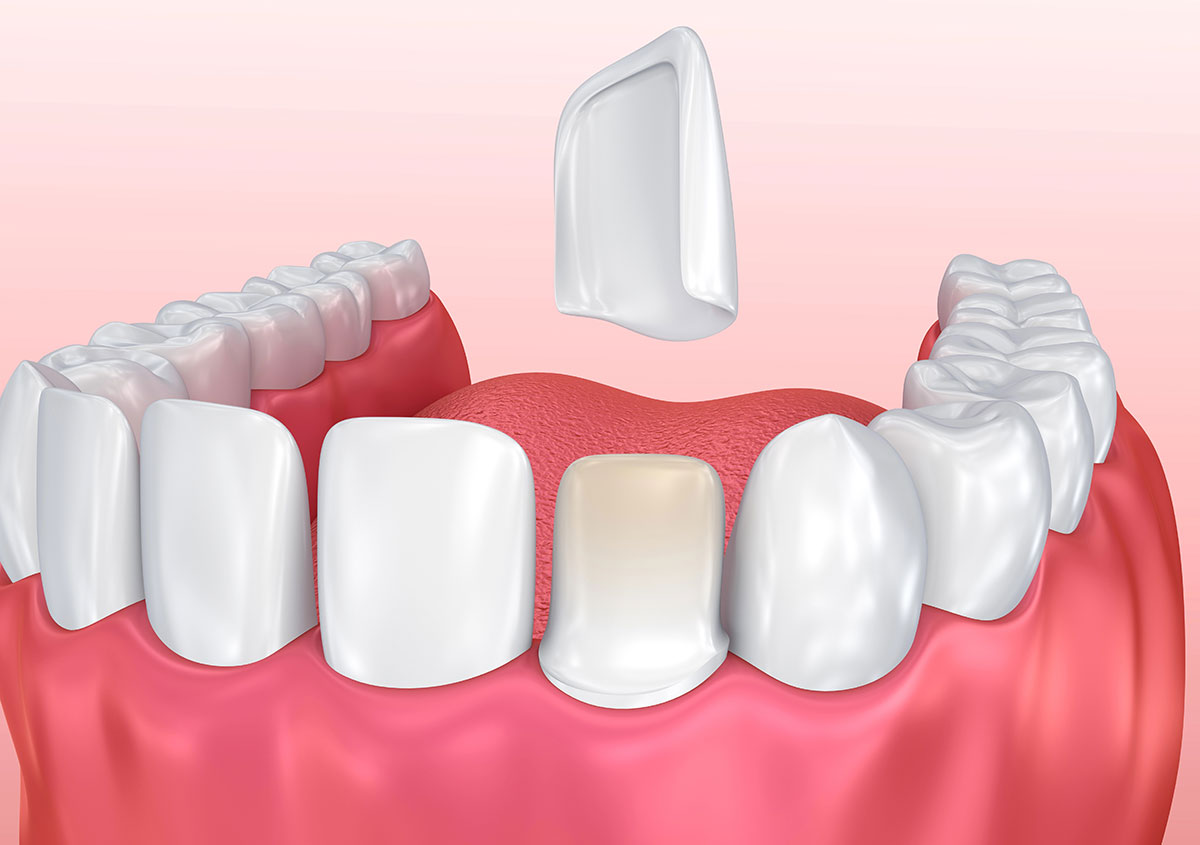Everything You Need to Know About Snap-On Veneers