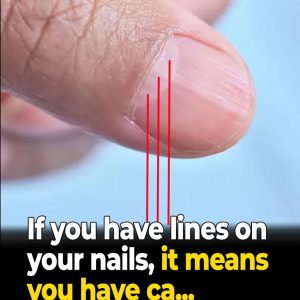 What Those Vertical Ridges on Your Fingernails Might Be Telling You — Especially After 40