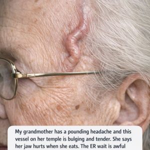 My grandmother has a pounding headache and this vessel on her temple is bulging and tender. She says her jaw hurts when she eats. The ER wait is awful right now. Is this an emergency?