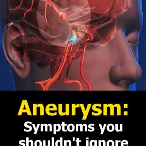Myth vs Fact: Brain Aneurysms — What People Get Wrong (And the Science That Sets the Record Straight)