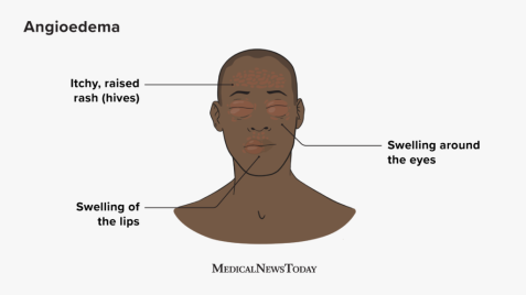  Hidden Risks Explored: Swelling (Angioedema)