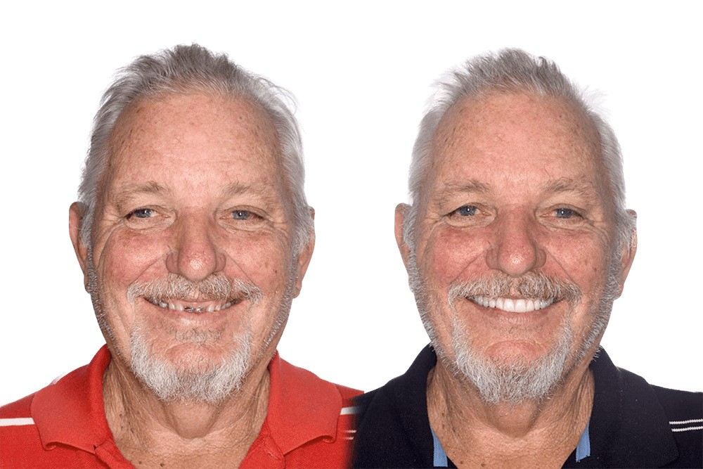 Affordable Dental Implants: Your Answer to Tooth Loss