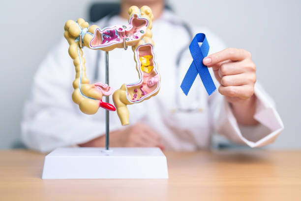 How to Know If You Have Colon Cancer (Lesser-Known Signs)