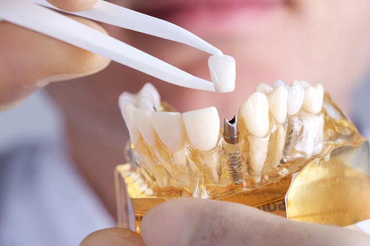 Exploring Medicare Coverage for Dental Implants