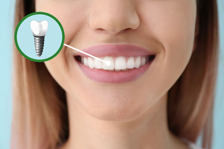 Choosing the Right Material for Your Dental Implants: A Comprehensive Guide 