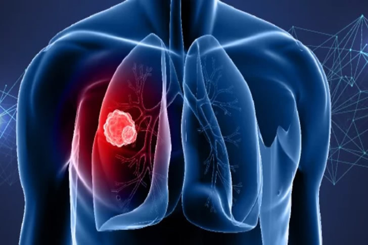 Early Signs of Lung Cancer: How to Recognize Them