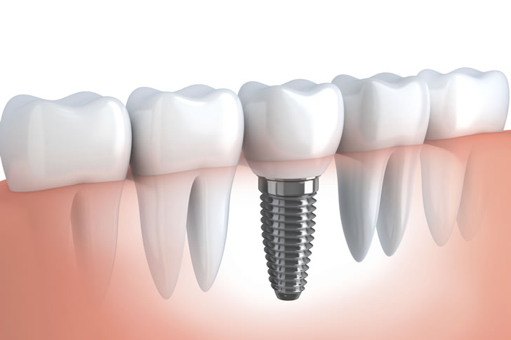 A Comprehensive Guide to Choosing the Best Tooth Replacement Option